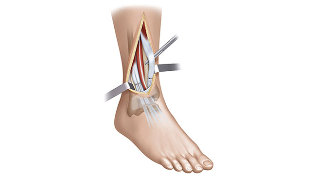 Transferts Tendineux